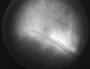 Fluorescein angiography of same patient as above d