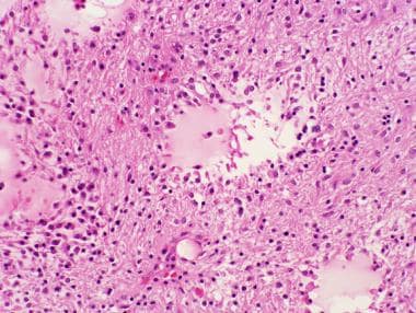Pathology of Expansile Astrocytomas. Higher magnif