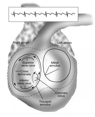 Catheter Ablation. Schema of the common variety of