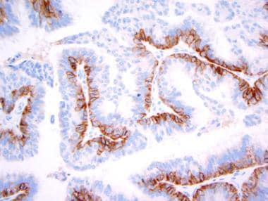 Pathology of small, peripheral intraductal papillo