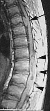 Sagittal T1-weighted postcontrast image of the tho