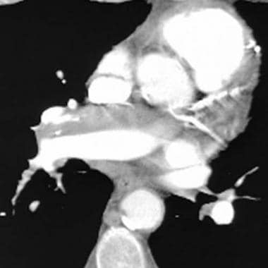 Computed tomography angiogram in a 69-year-old man