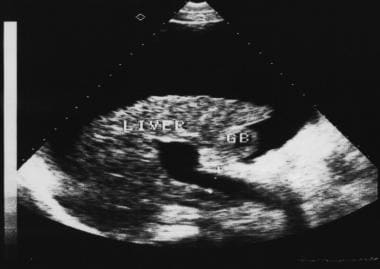 End-stage liver cirrhosis showing a small liver, g