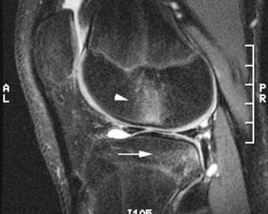 Sagittal T2-weighted image of the knee 2 weeks aft