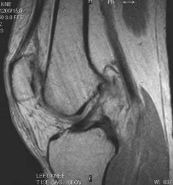 Chronic tear of the ACL, with false-negative MRI r