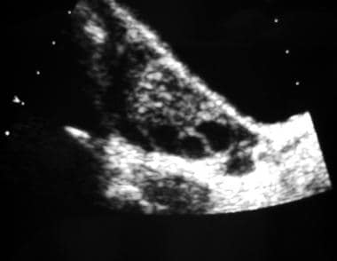 Longitudinal transabdominal sonogram of an ovary. 