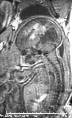 Sagittal spoiled gradient-recalled echo magnetic r