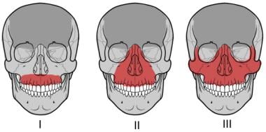 LeFort fractures of the maxilla. 