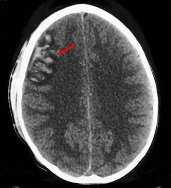 Subarachnoid hemorrhage - Emergency neuroradiology