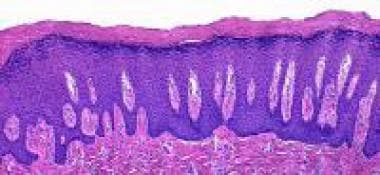 frictional squamous hyperkeratosis oral low power acanthosis workup epithelium stratified prominent marked catherine granular layer cell courtesy