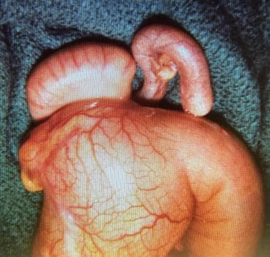 Intestinal obstruction in the newborn. Multiple at