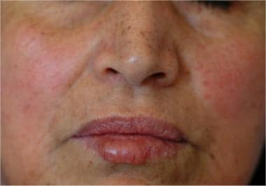 About 75% of patients have cheilitis, which can ta