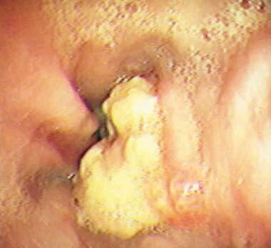 Gastroesophageal Reflux Disease. Endoscopy demonst