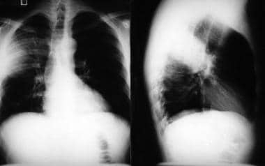 Bacterial pneumonia. Radiographic images in a pati
