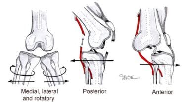 Types of knee dislocation. 