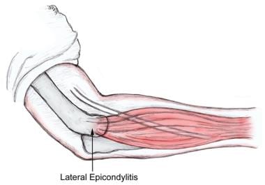 Lateral epicondyle steroid injection technique