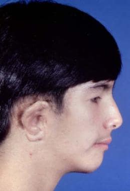Treatment of hemicraniofacial microsomia. Preopera