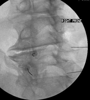 Epidural steroid injection contraindications