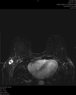 MRI: A, Non-fat saturation T1 weighted image showi