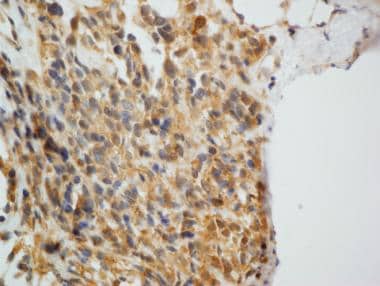 Pathology of nonmesothelial cancers of the pleura.