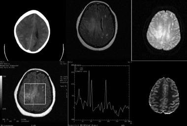 Low-grade astrocytoma in a 52-year-old woman. Top 