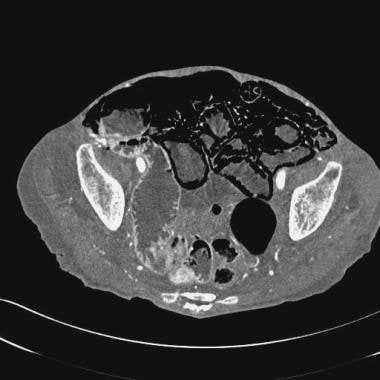 Computed tomography (CT) scan in a soft-tissue win