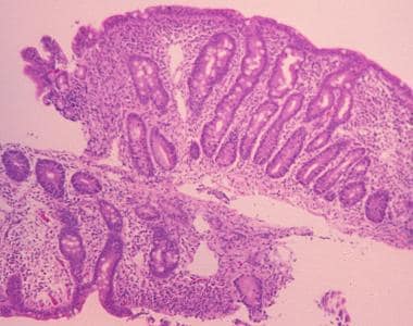 Sprue. High-powered photomicrograph of a duodenal 
