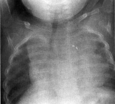 Radiograph in an infant with polysplenia. This ima