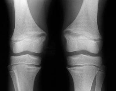 Radiograph of the knees of an 11-year-old boy with