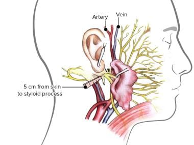 The surgical anatomy and landmarks of the facial n