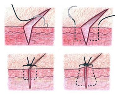 Simple interrupted suture placement. Bottom right 