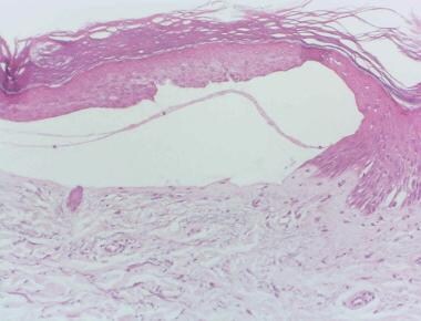 Maschera di purificazione di faccia profonda