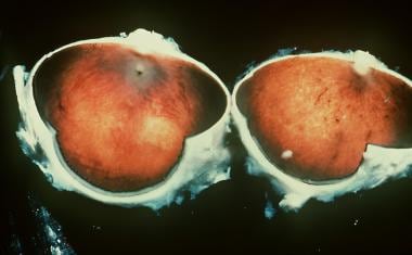 Gross pathology of an eye in a man with retinitis 