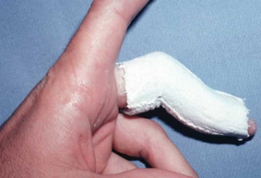 Skin-tight plaster cast can effectively hold dista