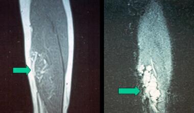 T1 and T2 MRI images of intramuscular hemangioma o