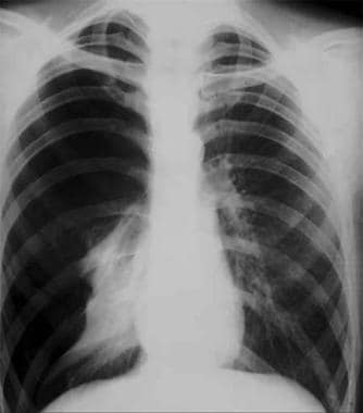 Radiograph of patient with a complete right-side p