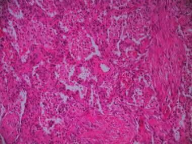 Severe acute rejection within 10 days of lung tran