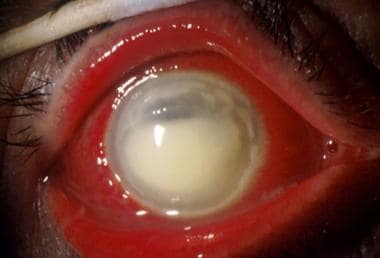Stromal haze with opacification of the cornea. 