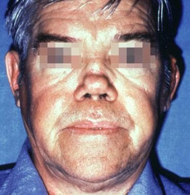 Patient with a history of relapsing polychondritis