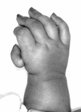 Photograph showing hypoplastic right thumb of the 