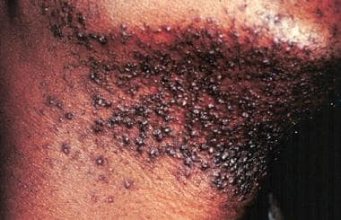 Man with pseudofolliculitis barbae on his neck.