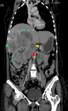 This coronal CT reconstruction shows right adrenal