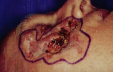 Basal cell carcinoma of the skin. Intraoperative v