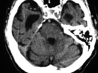 Axial nonenhanced computed tomography (CT) scan of