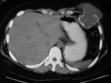 CT scan of the abdomen shows an expanding mass tha