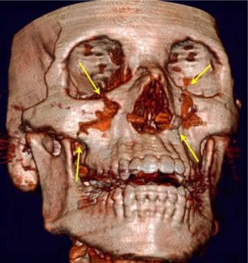Thoracic spine trauma. Three-dimensional CT scan o