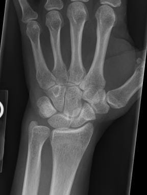 Posteroanterior radiograph of the wrist demonstrat