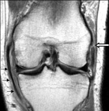 Acute tear of the proximal portion of the lateral 