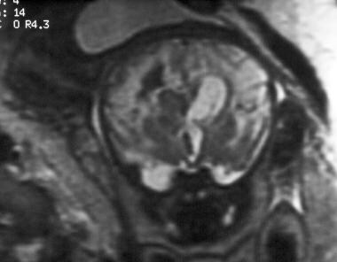 Coronal single-shot, fast spin-echo, T2-weighted m