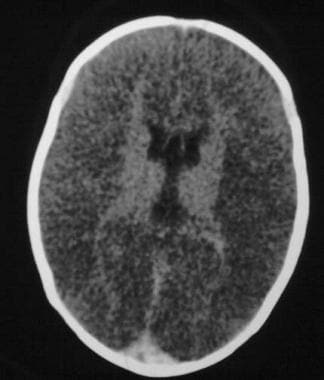 Diffuse axonal hemorrhage - Emergency neuroradiolo